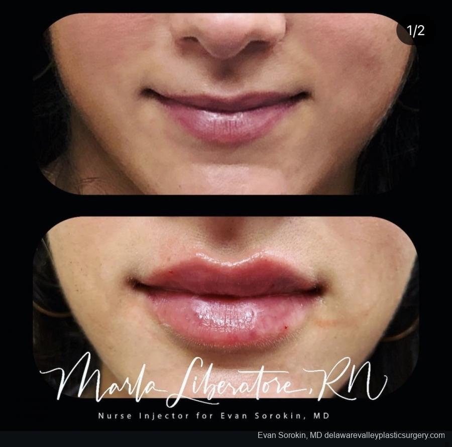 Lip Augmentation: Patient 20 - Before and After Image 1