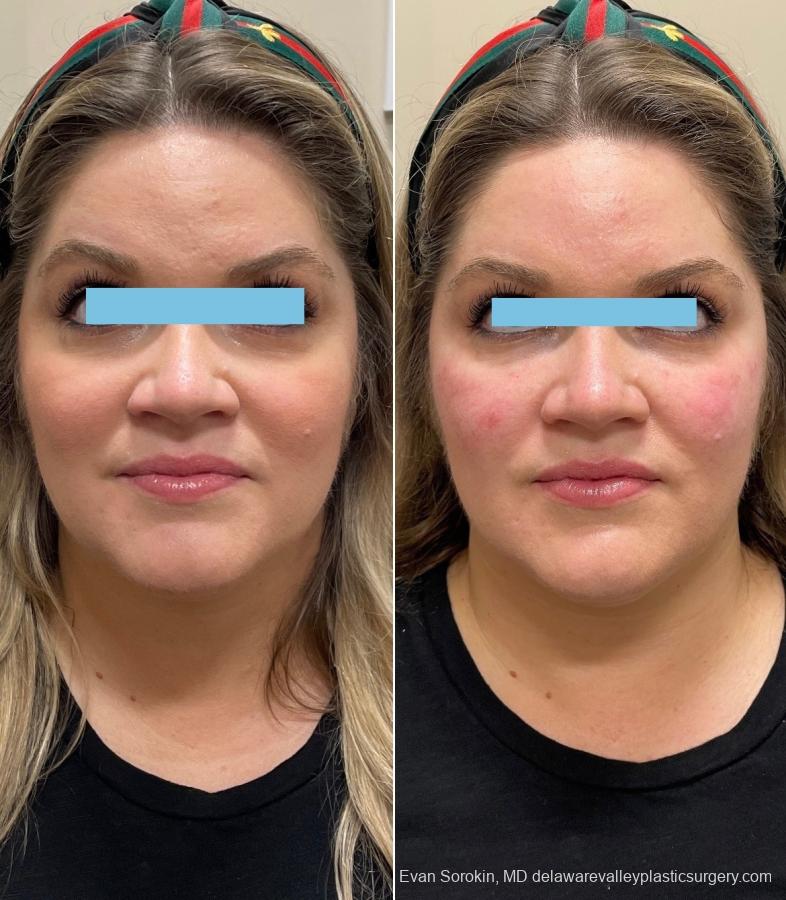 Fillers: Patient 20 - Before and After 1