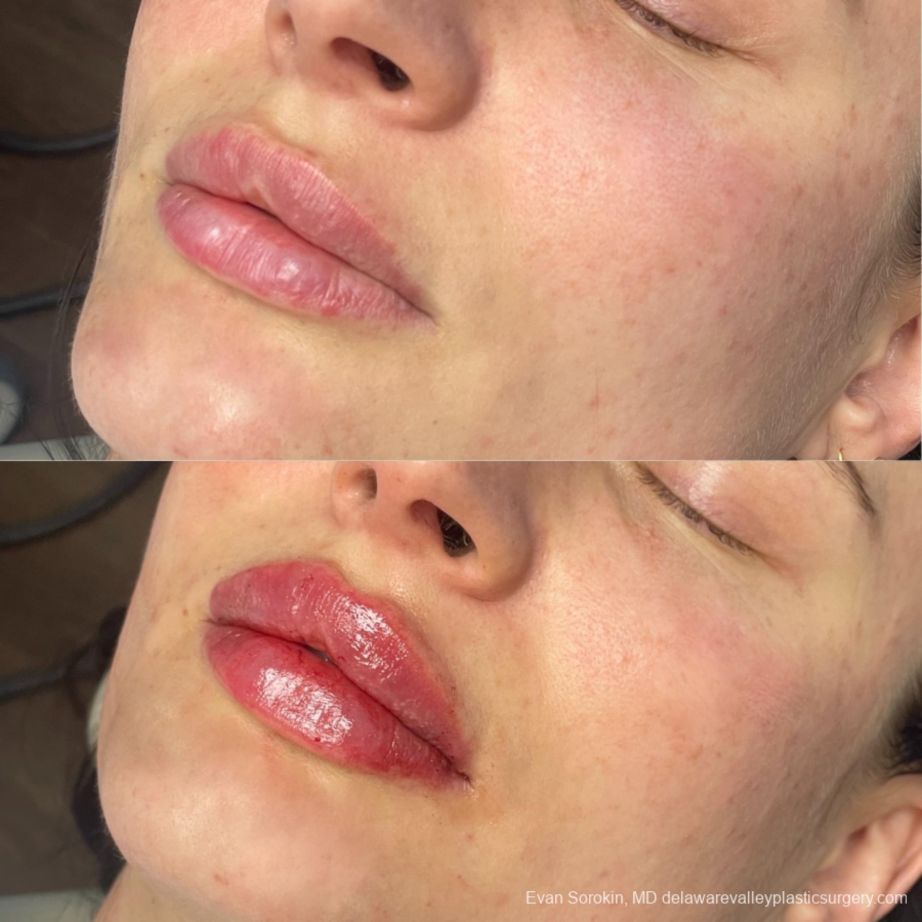 Lip Filler: Patient 63 - Before and After 3