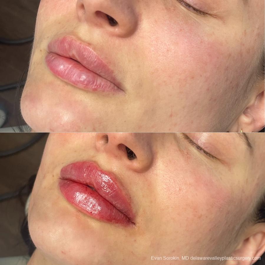 Lip Filler: Patient 64 - Before and After 3