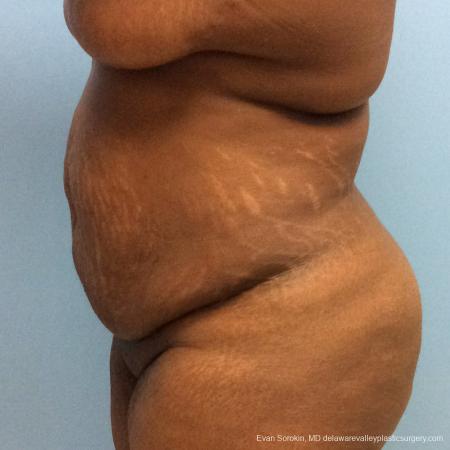 Philadelphia Abdominoplasty 10817 - Before and After Image 5