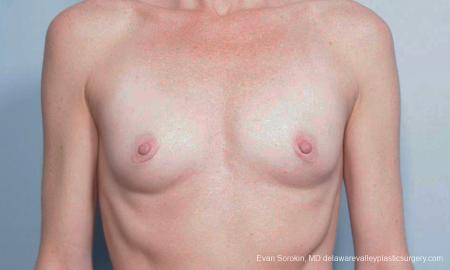 Philadelphia Breast Augmentation 9459 - Before Image 1