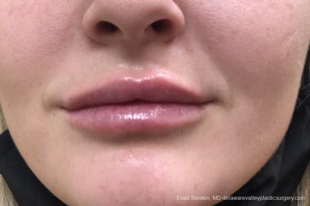 Lip Filler: Patient 14 - After Image 1