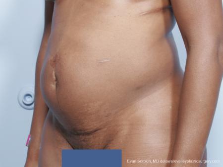 Philadelphia Abdominoplasty 9339 - Before Image 4