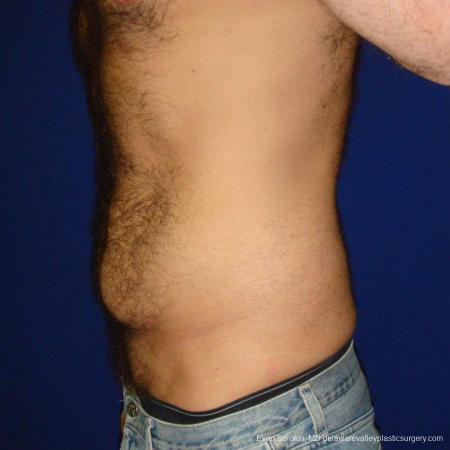 Philadelphia Abdominoplasty 9468 - Before and After Image 5