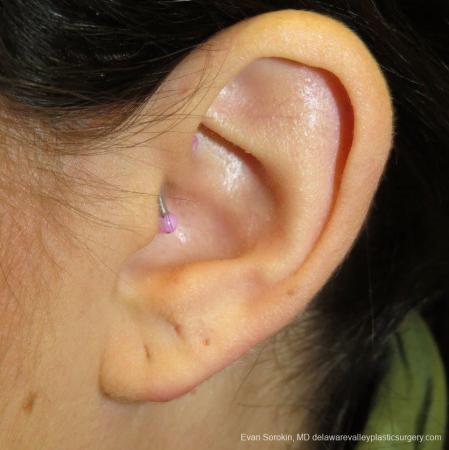 Philadelphia Earlobe Surgery 9384 - Before Image 2