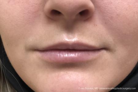 Lip Filler: Patient 14 - Before Image 1