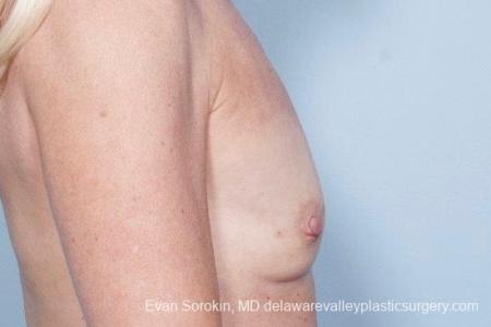 Philadelphia Breast Augmentation 8770 - Before Image 4