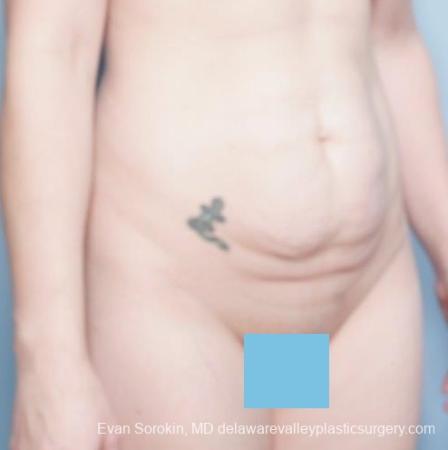 Philadelphia Abdominoplasty 8681 - Before Image 2