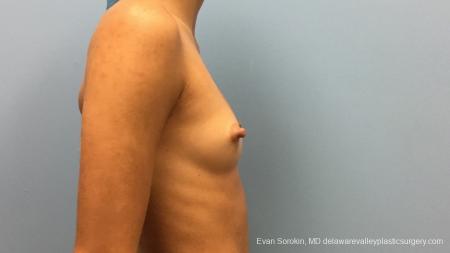 Philadelphia Breast Augmentation 13176 - Before Image 3