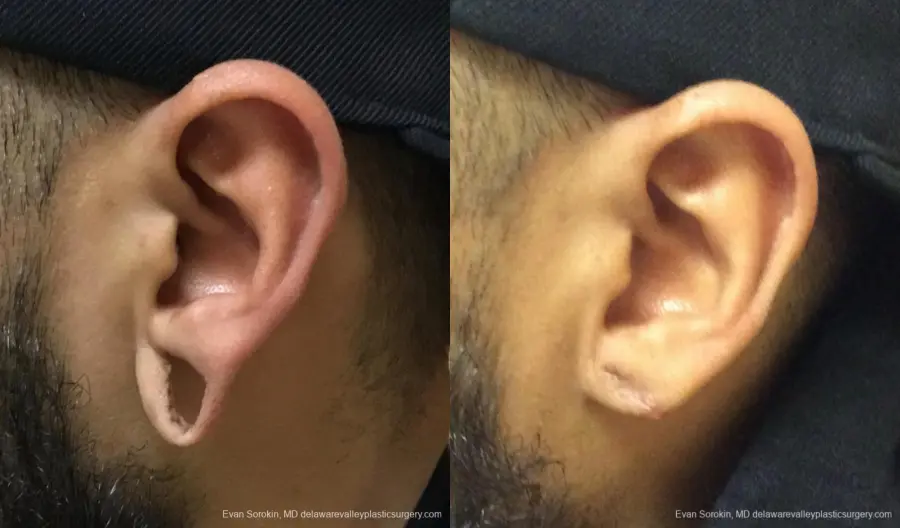 Philadelphia Earlobe Surgery 13181 - Before and After 1