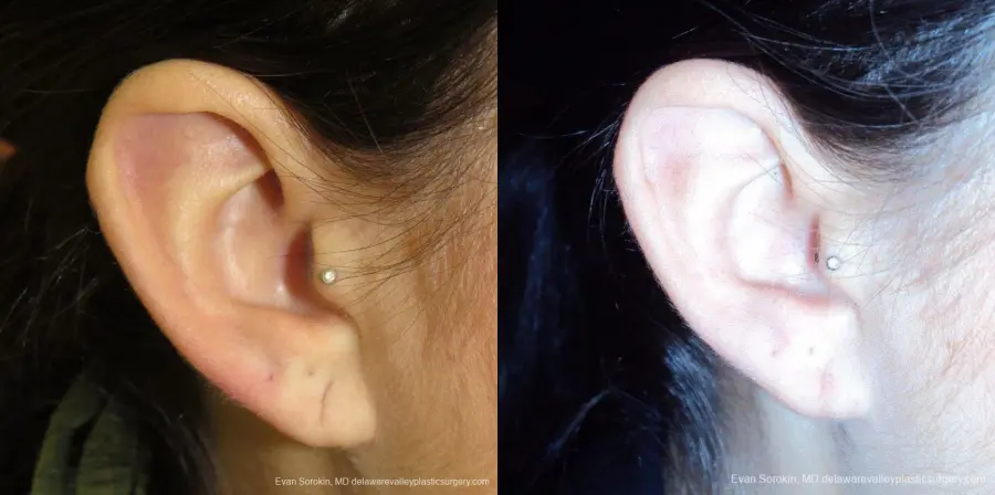 Philadelphia Earlobe Surgery 9384 - Before and After