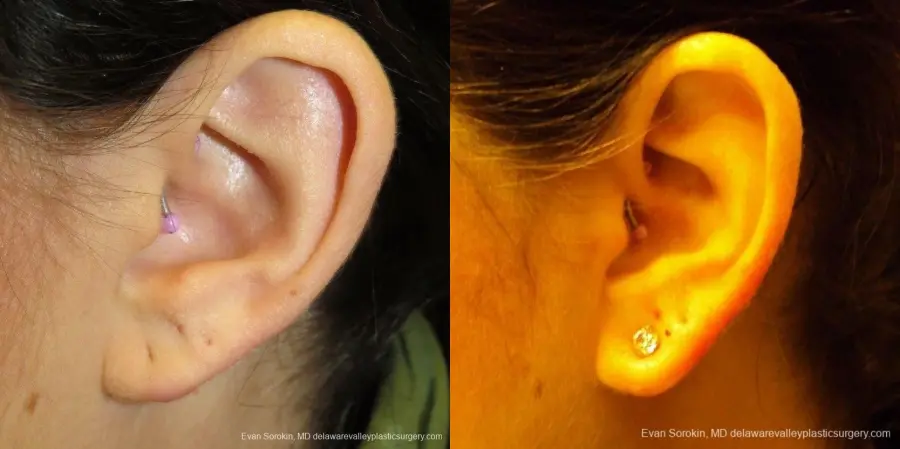 Philadelphia Earlobe Surgery 9384 - Before and After 4