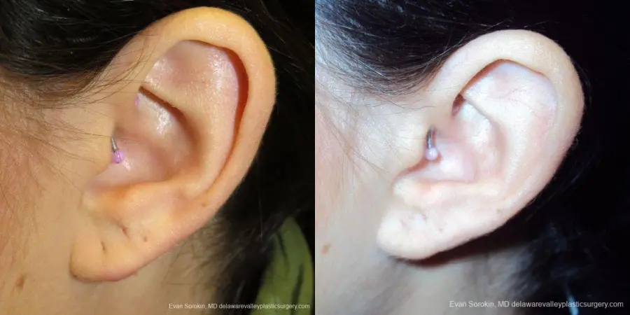 Philadelphia Earlobe Surgery 9384 - Before and After 2