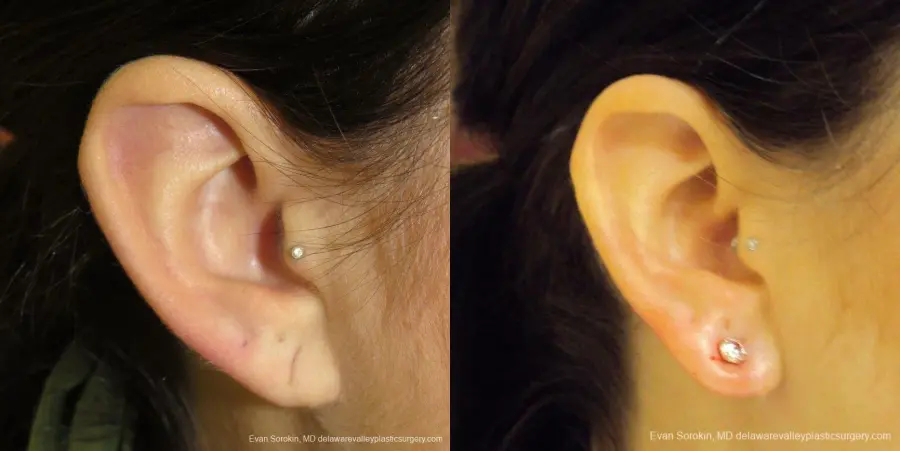 Philadelphia Earlobe Surgery 9384 - Before and After 3