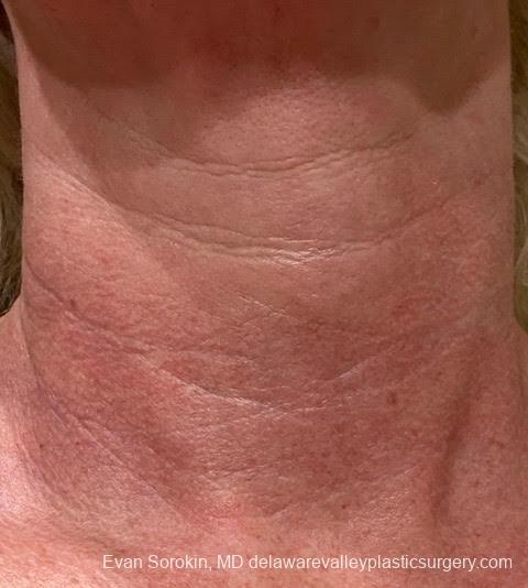 Microneedling: Patient 1 - Before 1