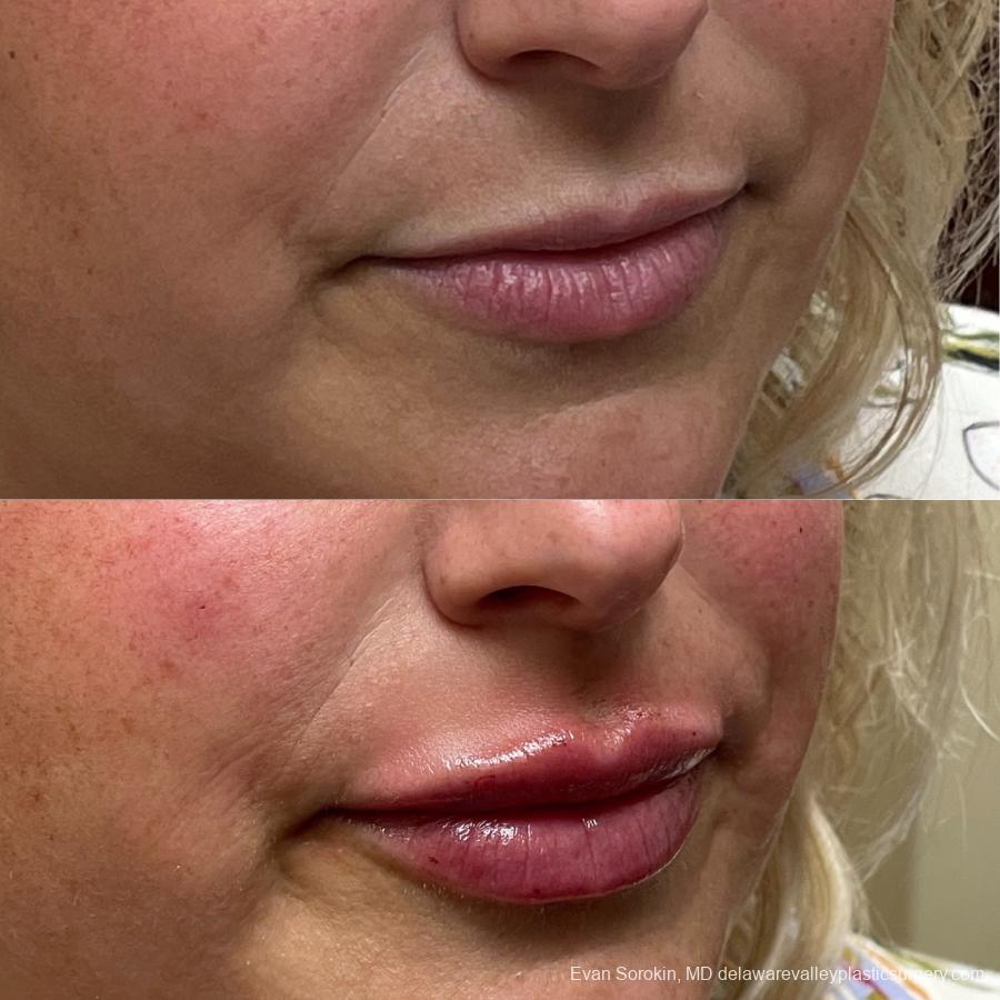 Lip Filler: Patient 6 - Before and After 2