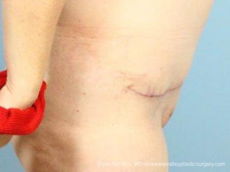 Philadelphia Abdominoplasty 9467 - After Image 3