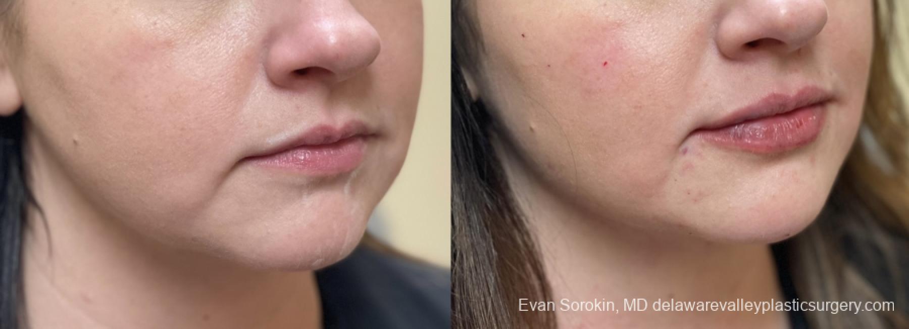 Lip Filler: Patient 49 - Before and After 2
