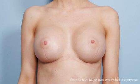 Philadelphia Breast Augmentation 8663 - After Image 1