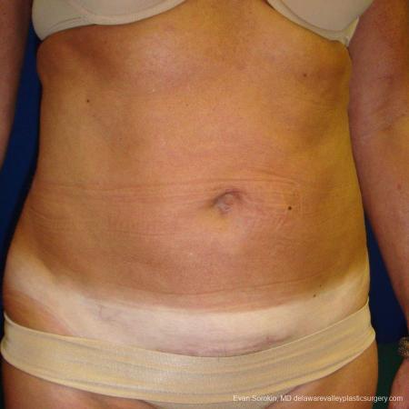 Philadelphia Liposuction 9488 - After Image 4