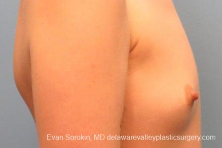 Philadelphia Breast Augmentation 10113 - Before Image 3