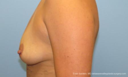 Philadelphia Breast Augmentation 9388 - Before and After Image 5