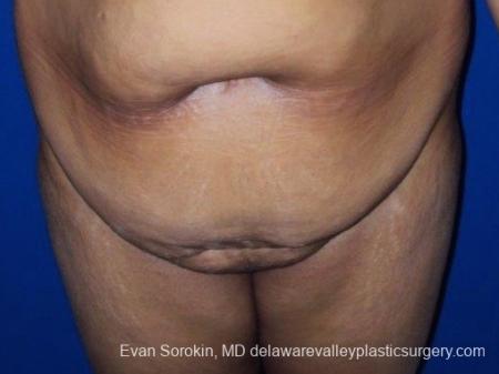Philadelphia Abdominoplasty 8700 - Before Image 1