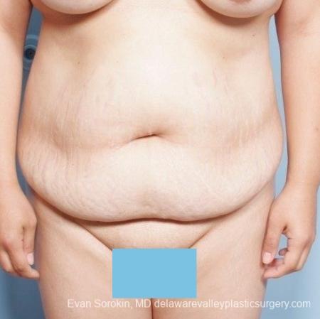 Philadelphia Abdominoplasty 8678 - Before Image 1