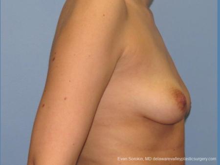 Philadelphia Breast Lift and Augmentation 10115 - Before Image 3