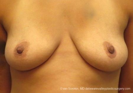 Philadelphia Breast Lift and Augmentation 8824 - Before 1