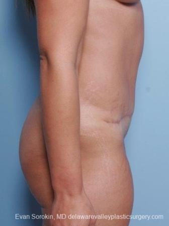 Philadelphia Abdominoplasty 8698 - After Image 4