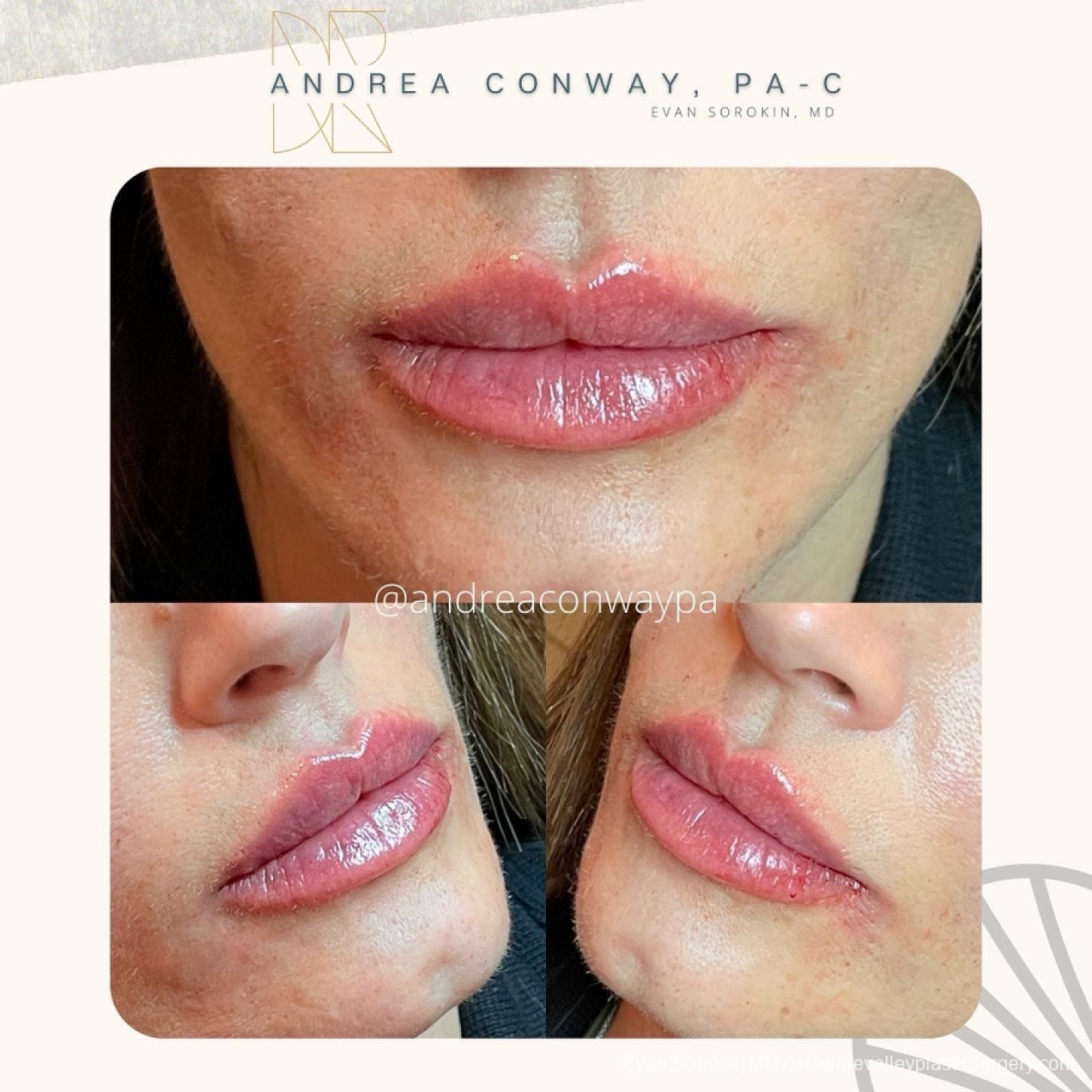 Lip Augmentation: Patient 31 - Before and After 1