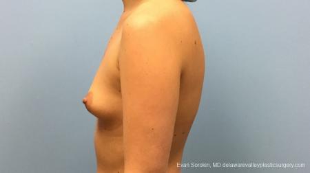 Philadelphia Breast Augmentation 12540 - Before and After Image 5