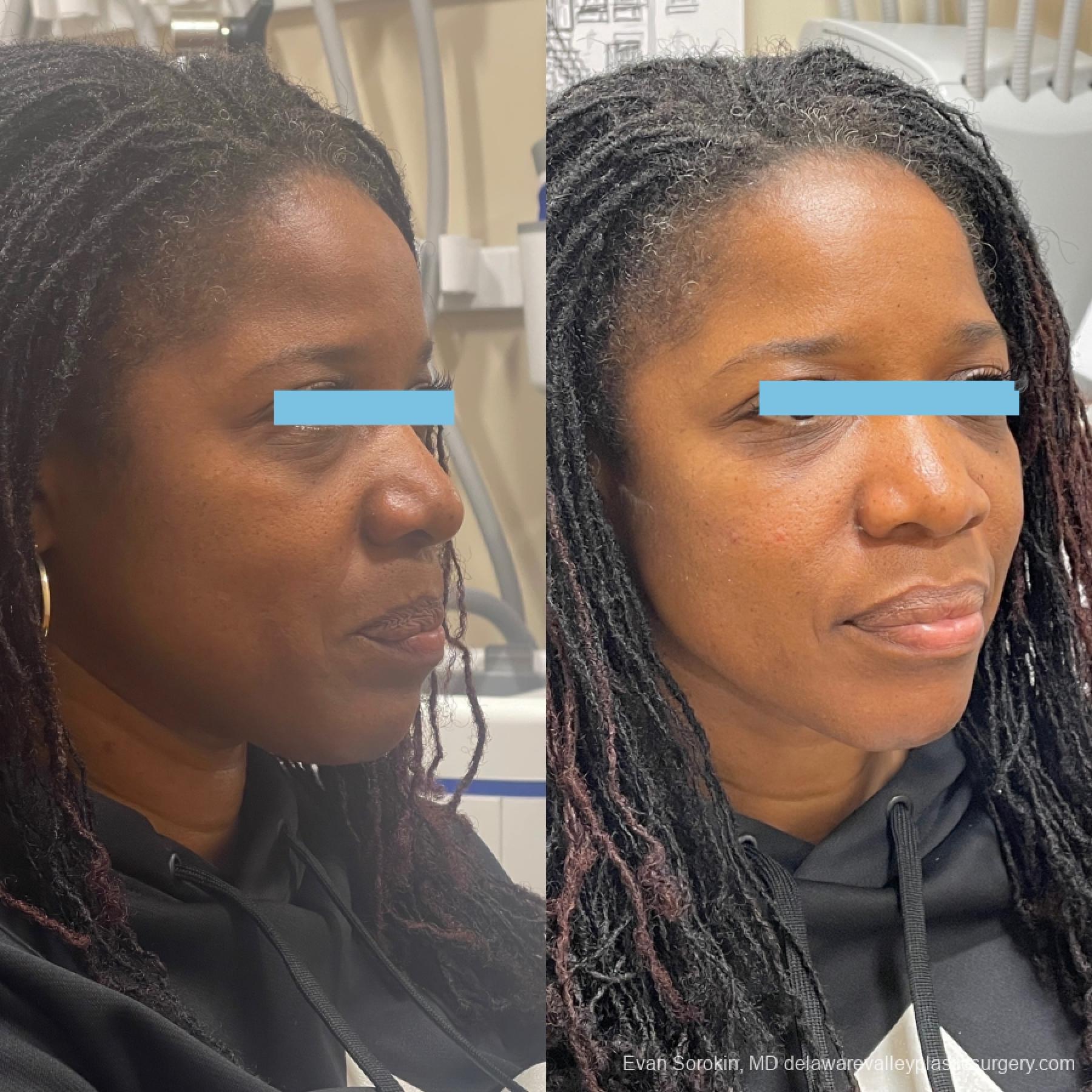 Fillers: Patient 1 - Before and After 2