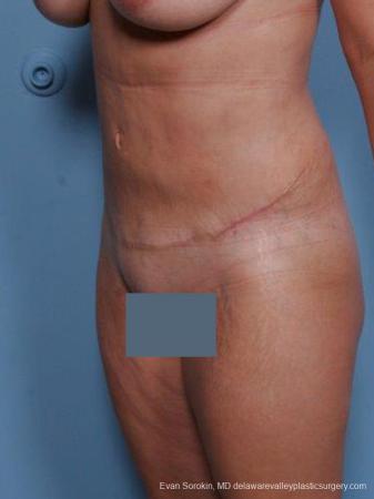 Philadelphia Abdominoplasty 9460 - After Image 4