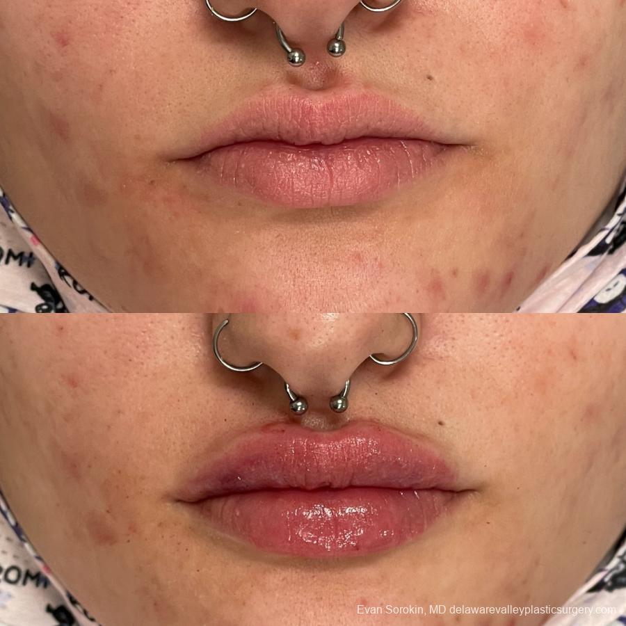 Lip Augmentation: Patient 7 - Before and After  