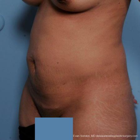 Philadelphia Abdominoplasty 9479 - Before Image 4