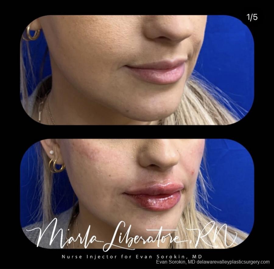 Lip Filler: Patient 20 - Before and After Image 1