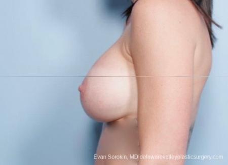 Philadelphia Breast Augmentation 8783 - After Image 5