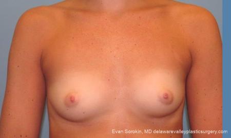 Philadelphia Breast Augmentation 9621 - Before Image 1