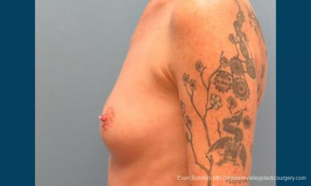 Philadelphia Breast Augmentation 9371 - Before and After Image 5