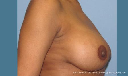 Philadelphia Breast Augmentation 10112 - Before and After Image 5