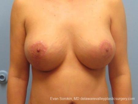 Philadelphia Breast Lift and Augmentation 8671 - After Image 1