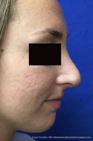 Rhinoplasty: Patient 2 - After Image 1