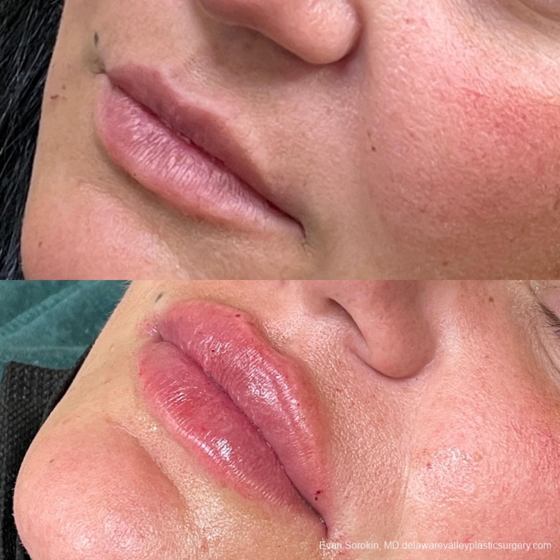 Lip Augmentation: Patient 1 - Before and After 2