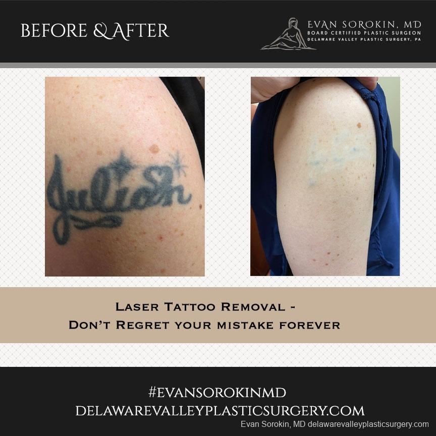 Tattoo Removal: Patient 4 - Before and After  
