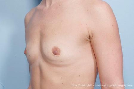 Philadelphia Breast Augmentation 8651 - Before Image 3