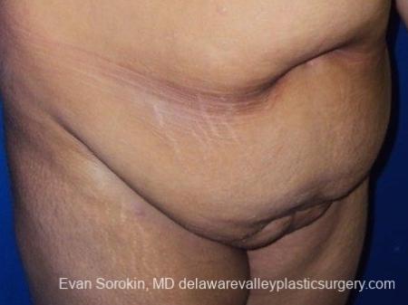 Philadelphia Abdominoplasty 8700 - Before Image 2