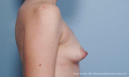 Philadelphia Breast Augmentation 9302 - Before Image 3